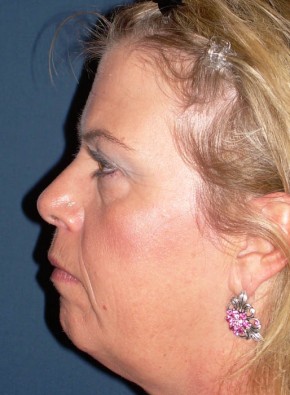 Before Image: Facial Rejuvenation – Facelift, Browlift, and Chin Implant - other