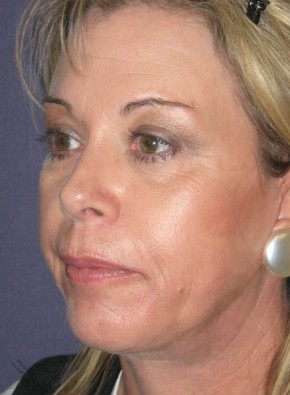 Facial Rejuvenation – Facelift, Browlift, and Chin Implant