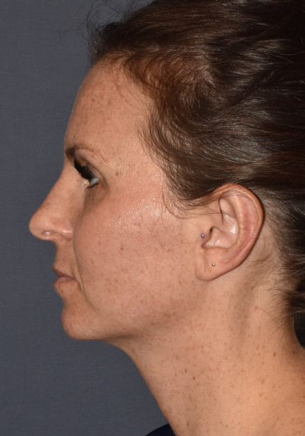 Otoplasty (ear surgery)