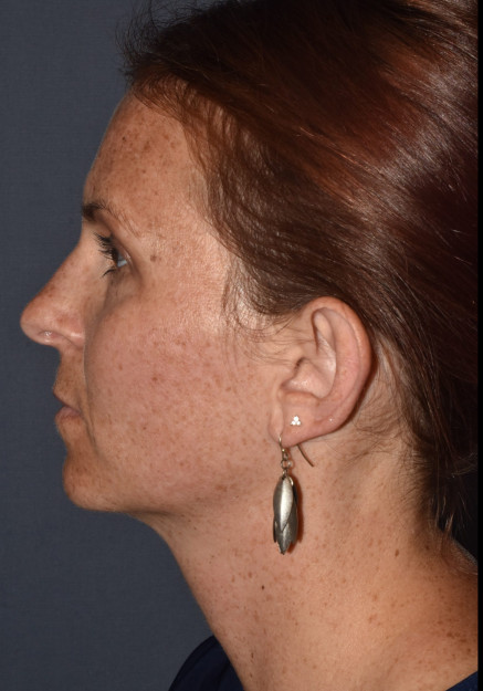 Otoplasty (ear surgery)
