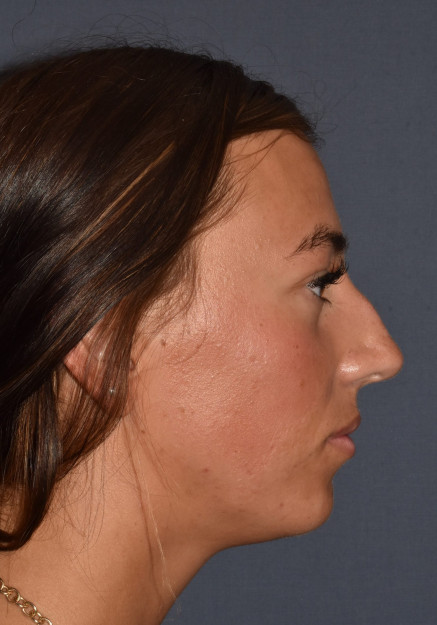 Rhinoplasty – Closed