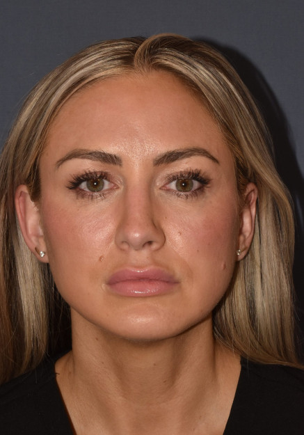 After Image: Rhinoplasty – Open