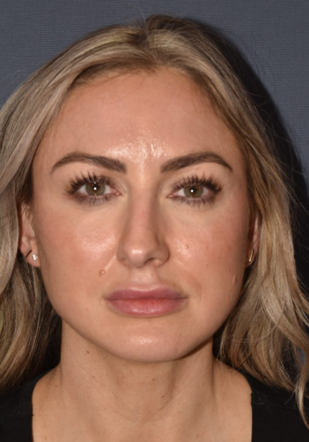 Before Image: Rhinoplasty – Open