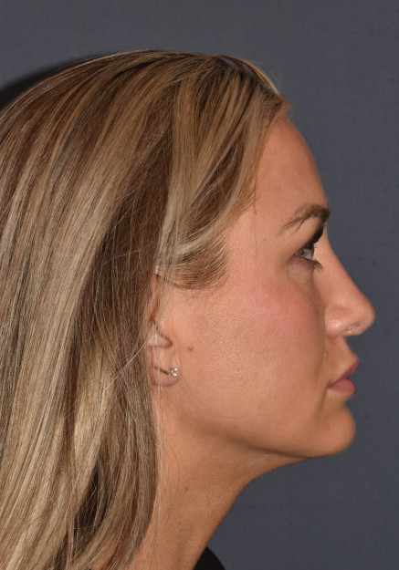 Rhinoplasty – Open