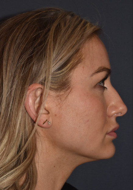 Rhinoplasty – Open