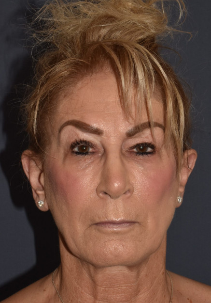 Before Image: Otoplasty (ear surgery) - front