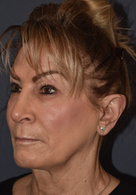 Otoplasty (ear surgery)