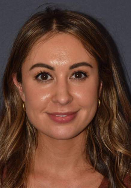 After Image: Rhinoplasty – Open - 