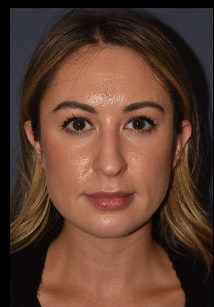 Before Image: Rhinoplasty – Open - 