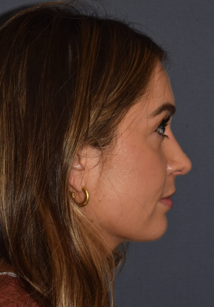 After Image: Rhinoplasty – Open