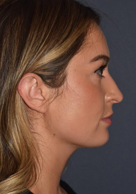 Before Image: Rhinoplasty – Open