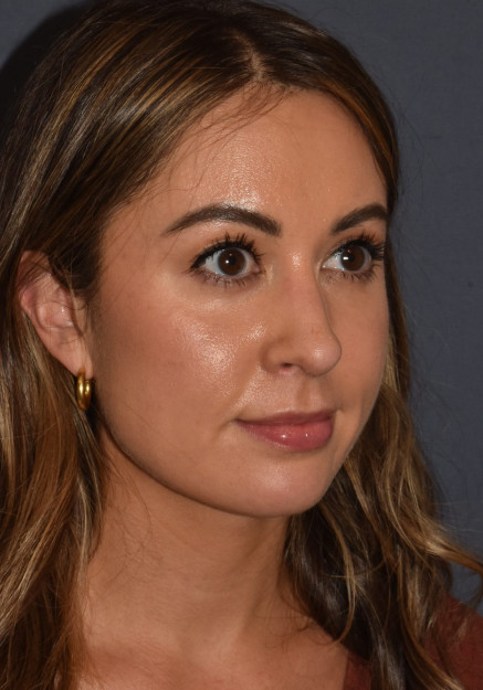 After Image: Rhinoplasty – Open - front