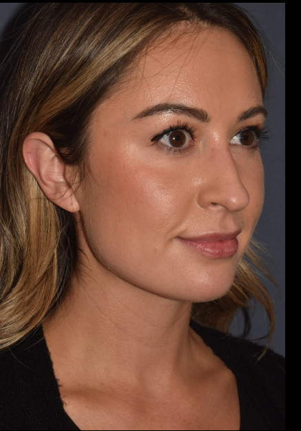Before Image: Rhinoplasty – Open - front