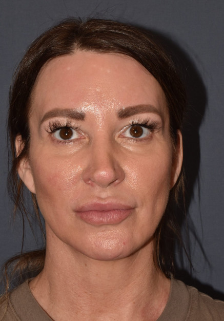 Rhinoplasty – Closed with Chin Implant