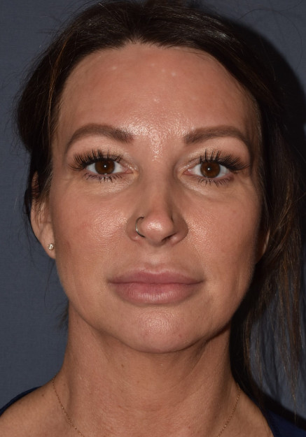 Rhinoplasty – Closed with Chin Implant