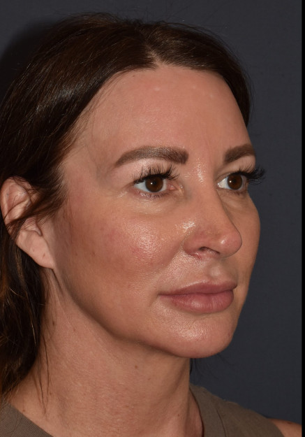 After Image: Rhinoplasty – Closed with Chin Implant - other