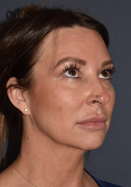 Before Image: Rhinoplasty – Closed with Chin Implant - other