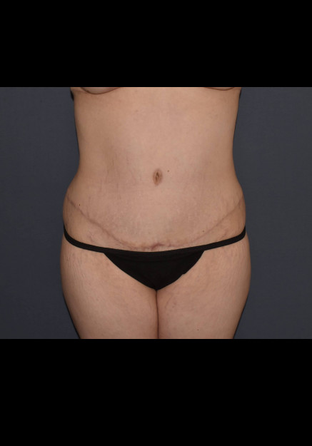 Mommy Makeover 6 – Abdominoplasty with Flank Liposuction