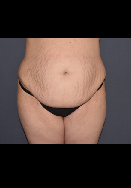 Mommy Makeover 6 – Abdominoplasty with Flank Liposuction