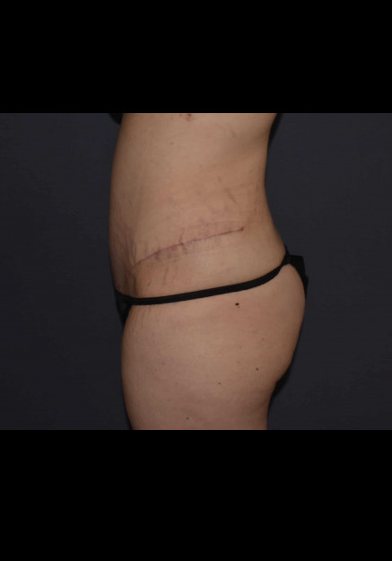 Mommy Makeover 6 – Abdominoplasty with Flank Liposuction