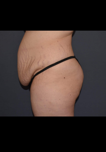 Mommy Makeover 6 – Abdominoplasty with Flank Liposuction