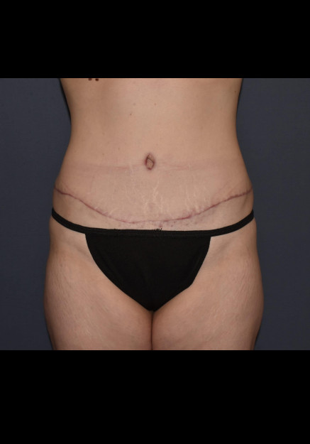 After Image: Mommy Makeover 7 – Abdominoplasty with Flank Liposuction - front