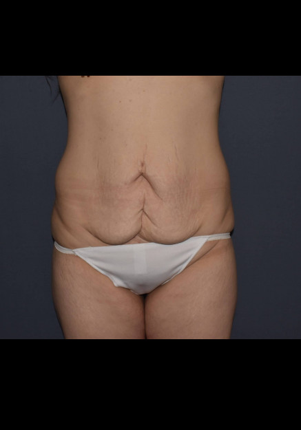 Mommy Makeover 7 – Abdominoplasty with Flank Liposuction