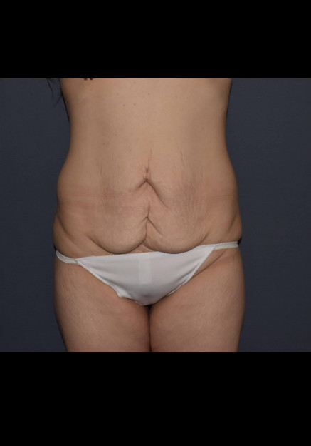 Before Image: Mommy Makeover 7 – Abdominoplasty with Flank Liposuction - front