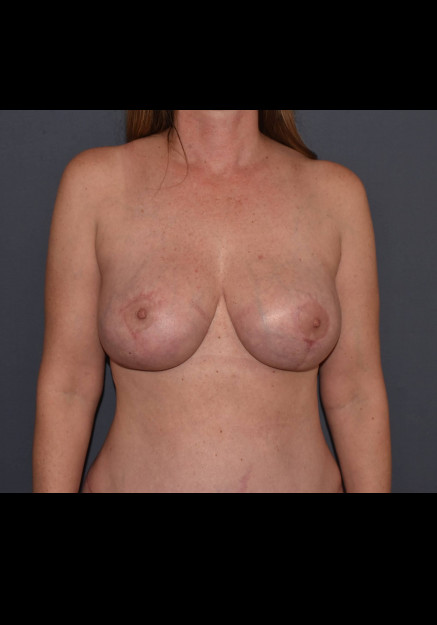 After Image: Mommy Makeover 8 – Mastopexy with Galatea Mesh - front