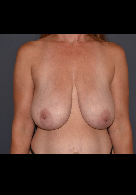 Before Image: Mommy Makeover 8 – Mastopexy with Galatea Mesh - front