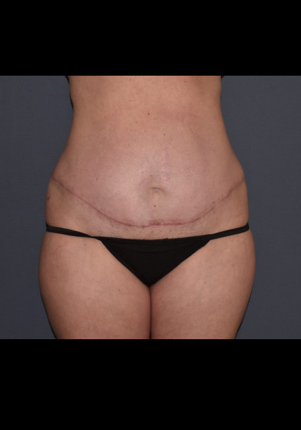 Mommy Makeover 8 – Mini Abdominoplasty with Flank Liposuction