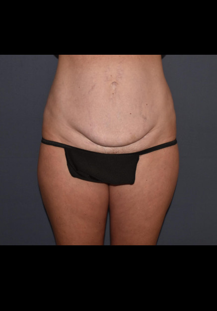 Mommy Makeover 8 – Mini Abdominoplasty with Flank Liposuction