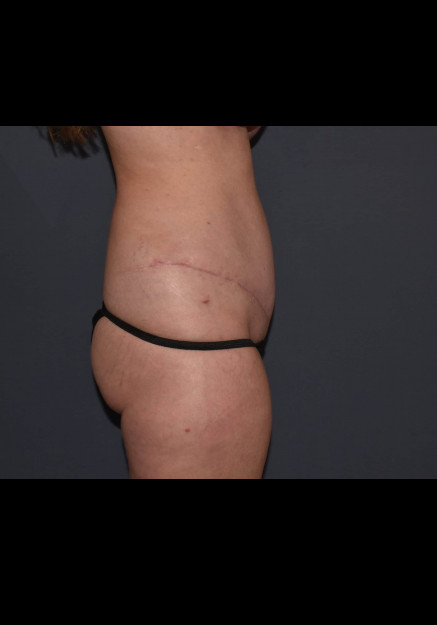 Mommy Makeover 8 – Mini Abdominoplasty with Flank Liposuction