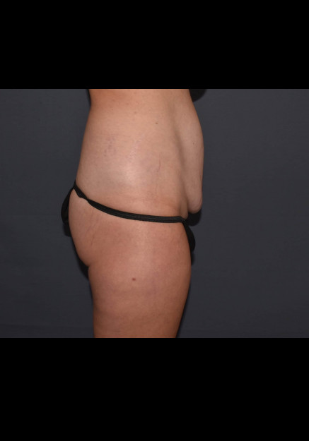 Mommy Makeover 8 – Mini Abdominoplasty with Flank Liposuction