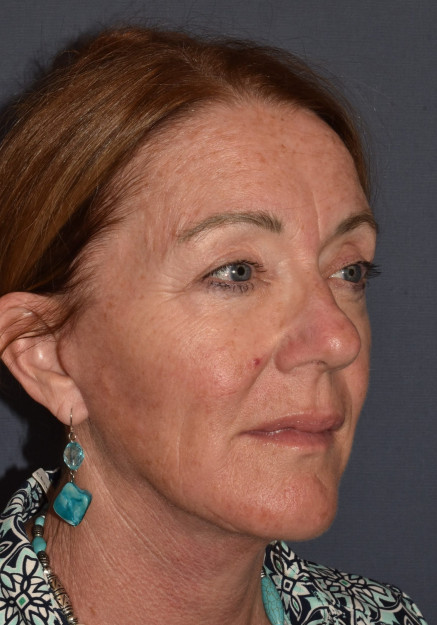After Image: Facial Rejuvenation – Facelift