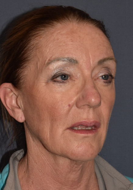 Before Image: Facial Rejuvenation – Facelift