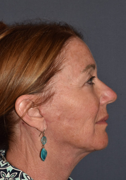 Facial Rejuvenation – Facelift