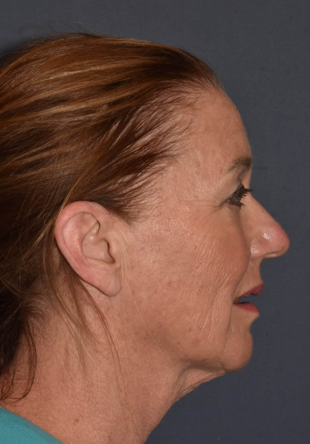 Facial Rejuvenation – Facelift