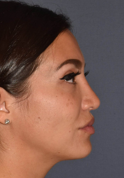 Rhinoplasty – Revision with Banked Cartilage