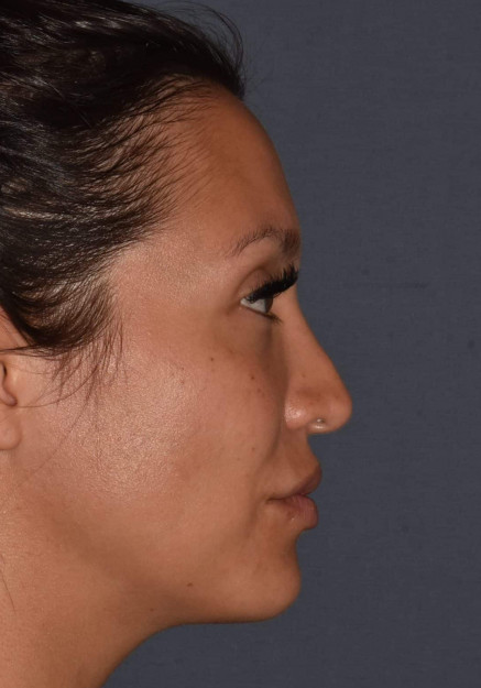 Rhinoplasty – Revision with Banked Cartilage