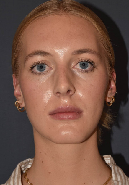 Rhinoplasty – Closed