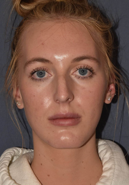 Rhinoplasty – Closed