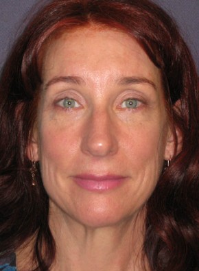 Facial Rejuvenation – Browlift and Upper Blepharoplasty