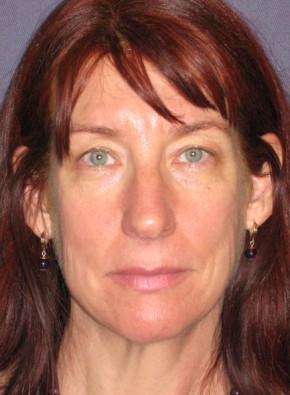 Facial Rejuvenation – Browlift and Upper Blepharoplasty