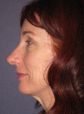 After Image: Facial Rejuvenation – Browlift and Upper Blepharoplasty - other
