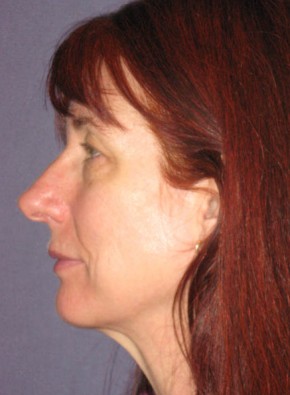 Before Image: Facial Rejuvenation – Browlift and Upper Blepharoplasty - other