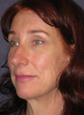 Facial Rejuvenation – Browlift and Upper Blepharoplasty