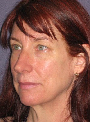 Facial Rejuvenation – Browlift and Upper Blepharoplasty