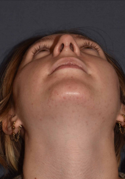 Rhinoplasty – Open with Functional Airway