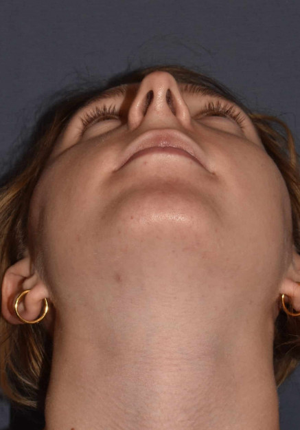 Rhinoplasty – Open with Functional Airway